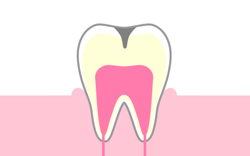 C2：象牙質に達した虫歯