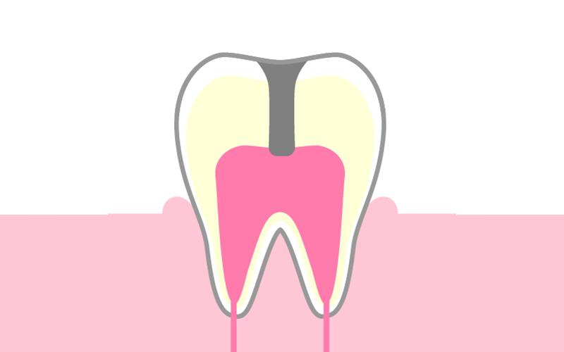 C3：歯髄（神経)に達した虫歯