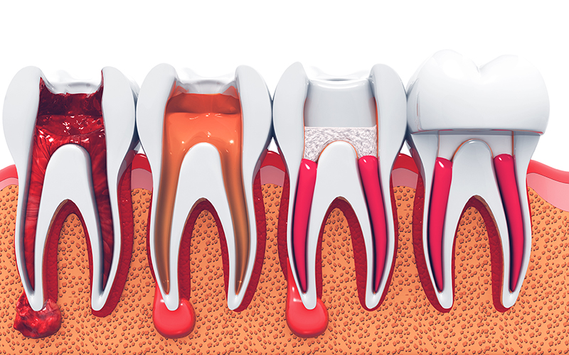 根管治療（歯内療法）とは